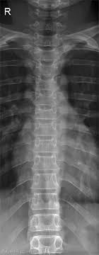 AP Thoracic Spine Breathing Technique - wikiRadiography